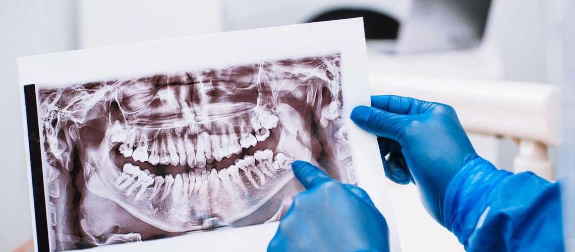 Que manger après une opération des dents de sagesse ? Que manger après une opération des dents de sagesse ?